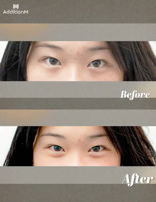 image shows before and after effect of under eye mask